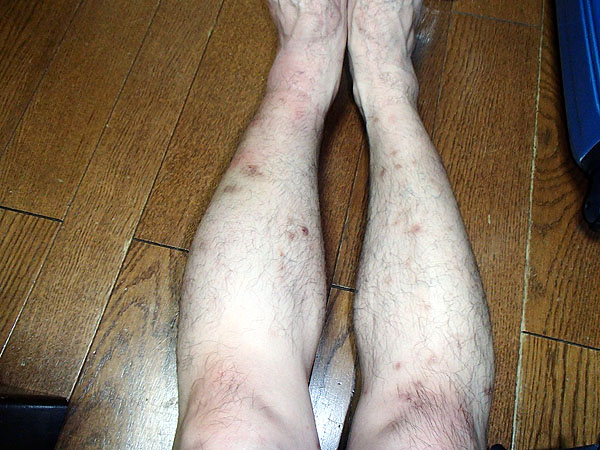 虫刺されで腫れた左足